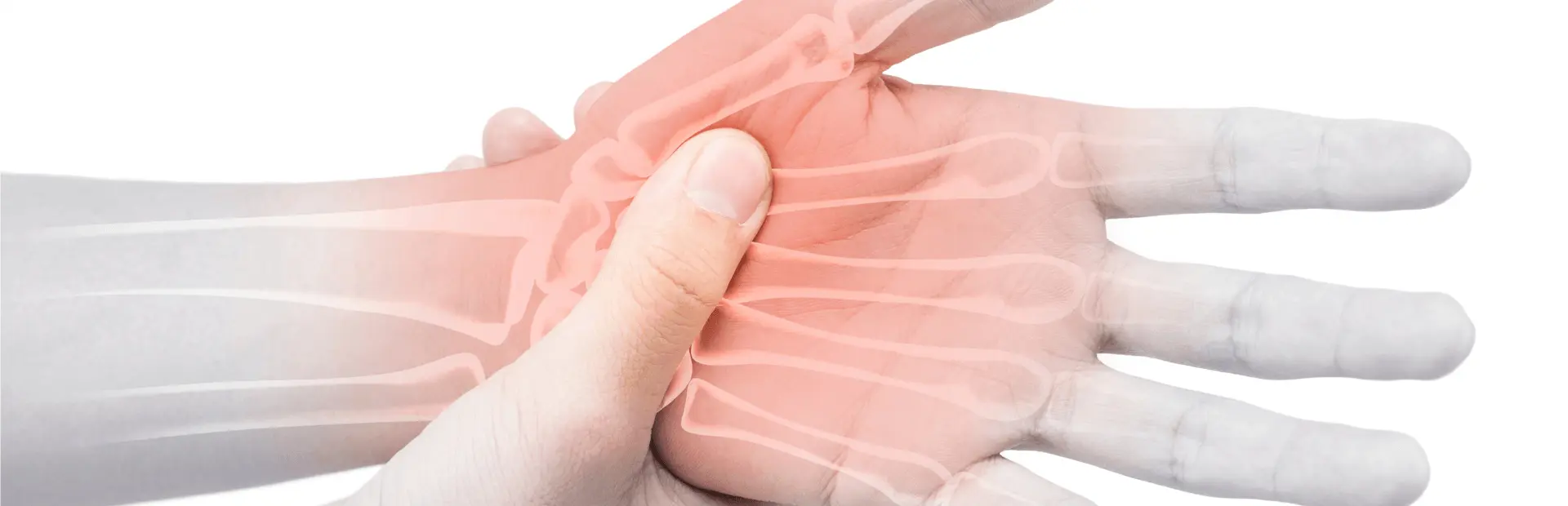 Illustratie van handpijn